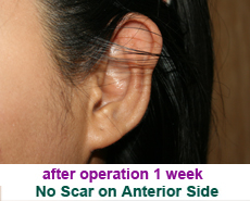 plastic-surgery-prominent-ear 